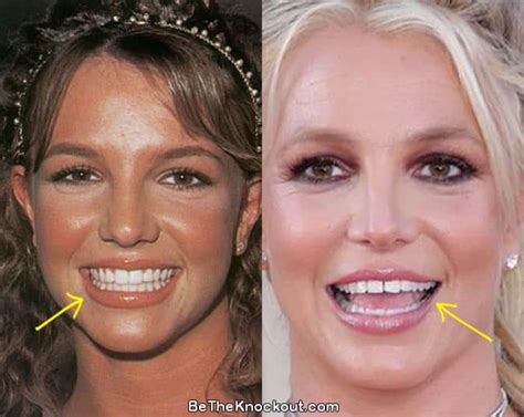 britney spears teeth|Why Britney Spears Teeth Sparked Major Concern。